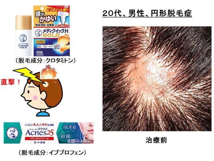 円形脱毛症　病院